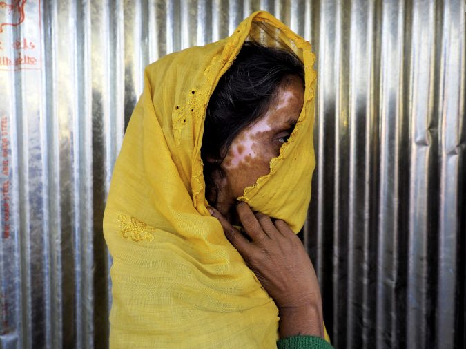 A Rohingya refugee displays her burn scars. Image by Doug Bock Clark. Bangladesh, 2017. Media file: screen_shot_2018-03-12_at_1.42.50_pm.png