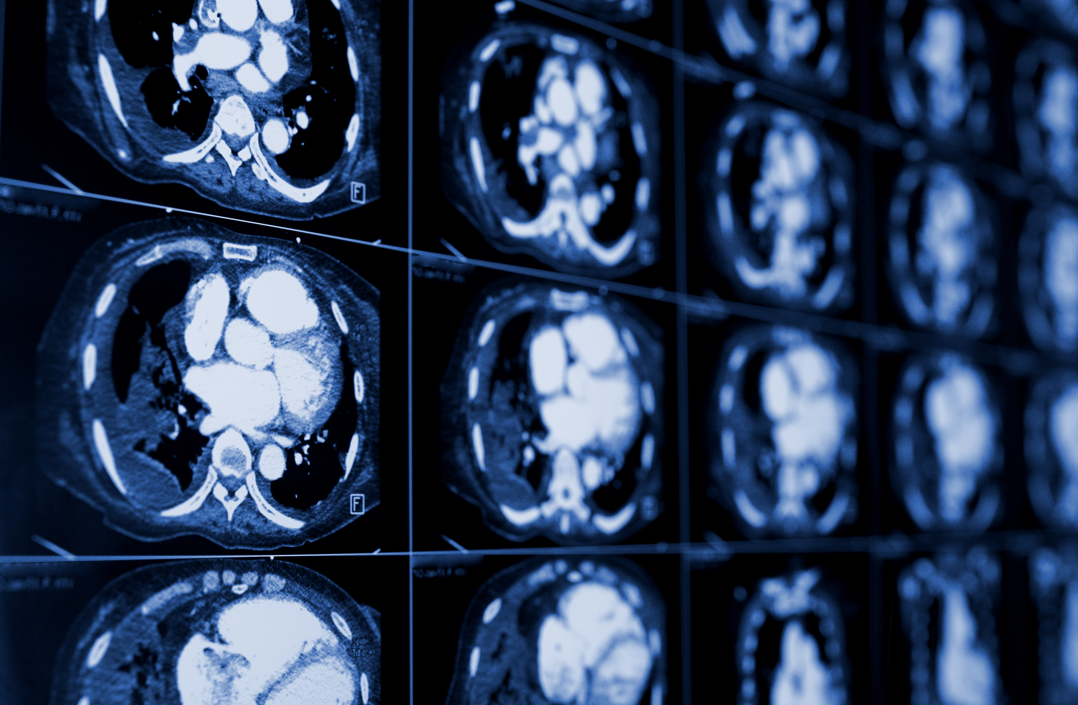 Computed tomography of the chest. Medical background. Monochrome photos. Image by sfam_photo/Shutterstock. Computed tomography of the chest. Medical background. Monochrome photos. Image by sfam_photo/Shutterstock.