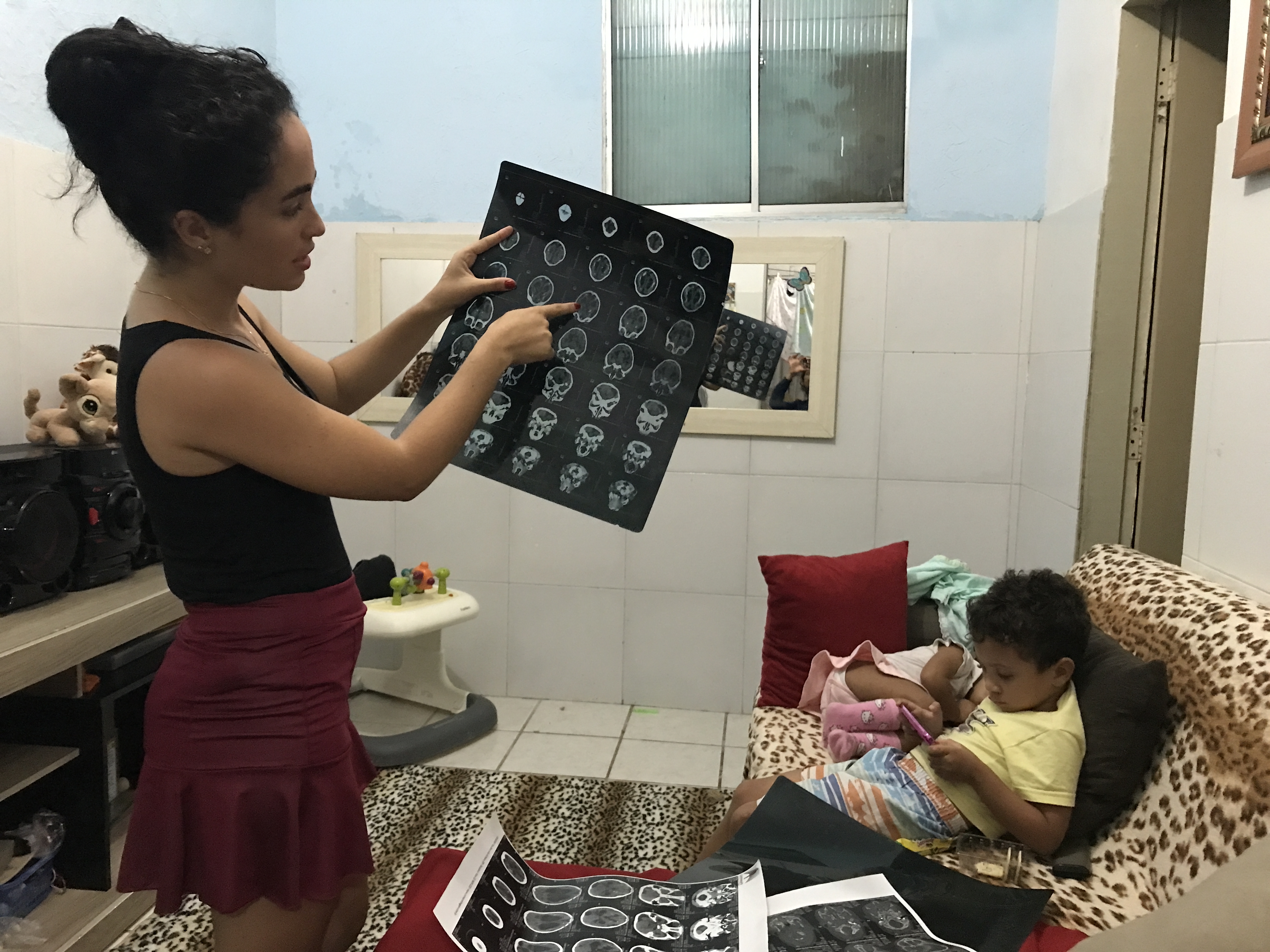 Dhulha Alen Silva do Nascimento, 25, has become skilled at reading and interpreting neuroimages since her youngest daughter, Valentina, was born nearly two years ago with congenital Zika syndrome. Here, she explains a CT scan of Valentina’s brain, pointing out areas of calcification and hydrocephalus. Image by Poonam Daryani. Brazil, 2017. Dhulha Alen Silva do Nascimento, 25, explains a CT scan of daughter Valentina’s brain, pointing out areas of calcification and hydrocephalus. Image by Poonam Daryani. Brazil, 2017.