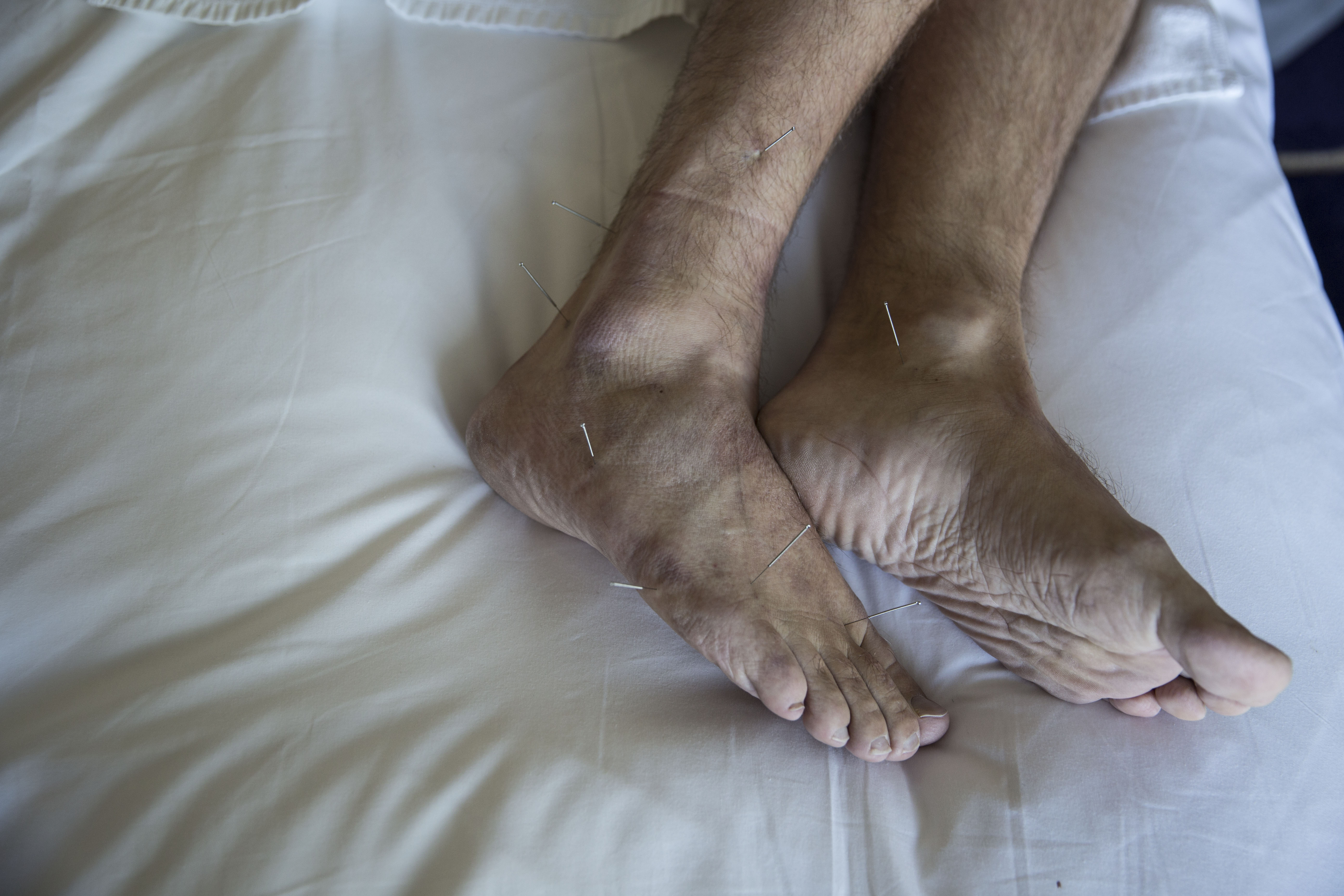 Tom Simons, of Carroll, Iowa, receives an acupuncture treatment from Dr. Zhang Shulin on Wednesday, Sept. 20, at the St. Regis hotel in Tianjin, China. The acupuncture is a part of series of Traditional Chinese Medicine treatments for stroke rehabilitation. Image by Kelsey Kremer. China, 2017. Tom Simons, of Carroll, Iowa, receives an acupuncture treatment from Dr. Zhang Shulin on Wednesday, Sept. 20, at the St. Regis hotel in Tianjin, China. The acupuncture is a part of series of Traditional Chinese Medicine treatments for stroke rehabilitation. Image by Kelsey Kremer. China, 2017.