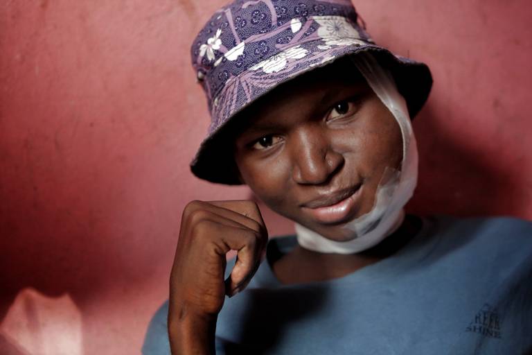A month after his 18th birthday in September, Djooly Jeune had his final chemotherapy for Burkitt’s lymphoma at the University Hospital of Mirebalais, in central Haiti. In November, his facial tumor started to grow again. Image by José A. Iglesias. Haiti, 2018. A month after his 18th birthday in September, Djooly Jeune had his final chemotherapy for Burkitt’s lymphoma at the University Hospital of Mirebalais, in central Haiti. In November, his facial tumor started to grow again. Image by José A. Iglesias. Haiti, 2018.