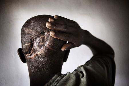 Masua Abaneru, 22, fisherman and father of three children, was abducted by the LRA and used as a porter. When he became too tired to continue, he was taken into the bush and the LRA commanders forced the children to hit him with sticks until he was dead. He woke up several days later and crawled to find help. Image by Marcus Bleasdale. Democratic Republic of Congo, 2010. Media file: LRAvictim_9471.jpg