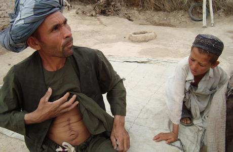 Mirza, of Oqa, shows a scar from an appendectomy. He had to sell both of his camels to pay hospital bills. Image by Anna Badkhen. Afghanistan, 2011