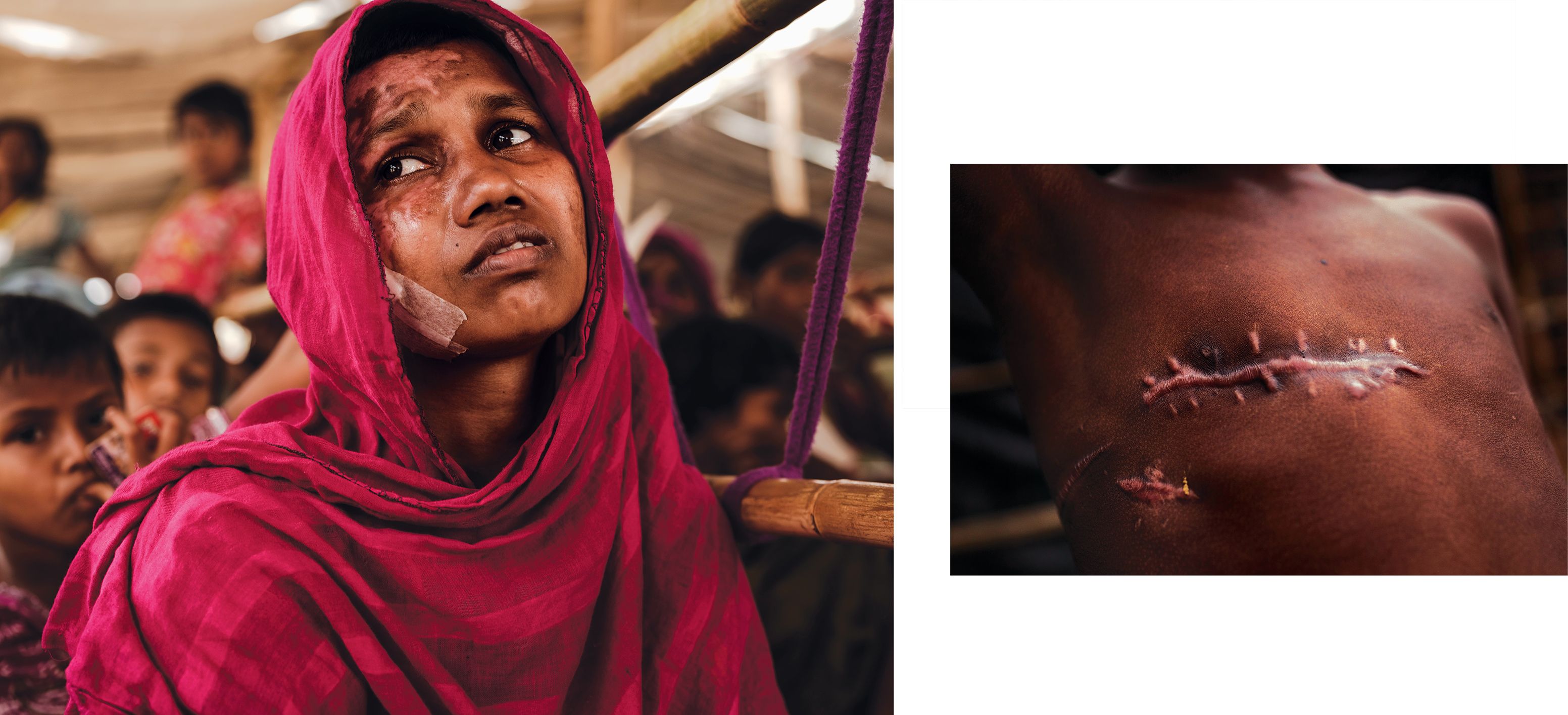 The physical evidence of atrocities is overwhelming among survivors in the refugee camps. Momtaz Begum (left) was treated for burns to her face and body. Seven year old Mohammad Shohail was shot in the chest. Image by Patrick Brown/Panos Pictures/UNICEF. Bangladesh, 2017. The physical evidence of atrocities is overwhelming among survivors in the refugee camps. Momtaz Begum (left) was treated for burns to her face and body. Seven year old Mohammad Shohail was shot in the chest. Image by Patrick Brown/Panos Pictures/UNICEF. Bangladesh, 2017.