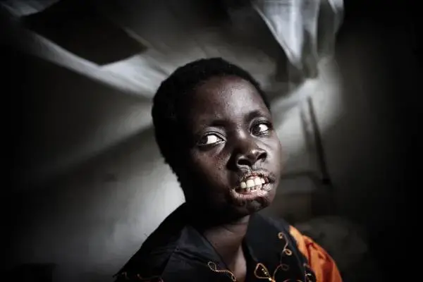 Mbonih Ndele Mari was abducted by Joseph Kony's LRA and later left for dead after they cut off her lips and her ears. Image by Marcus Bleasdale. Democratic Republic of Congo, 2010. Media file: 001.jpg