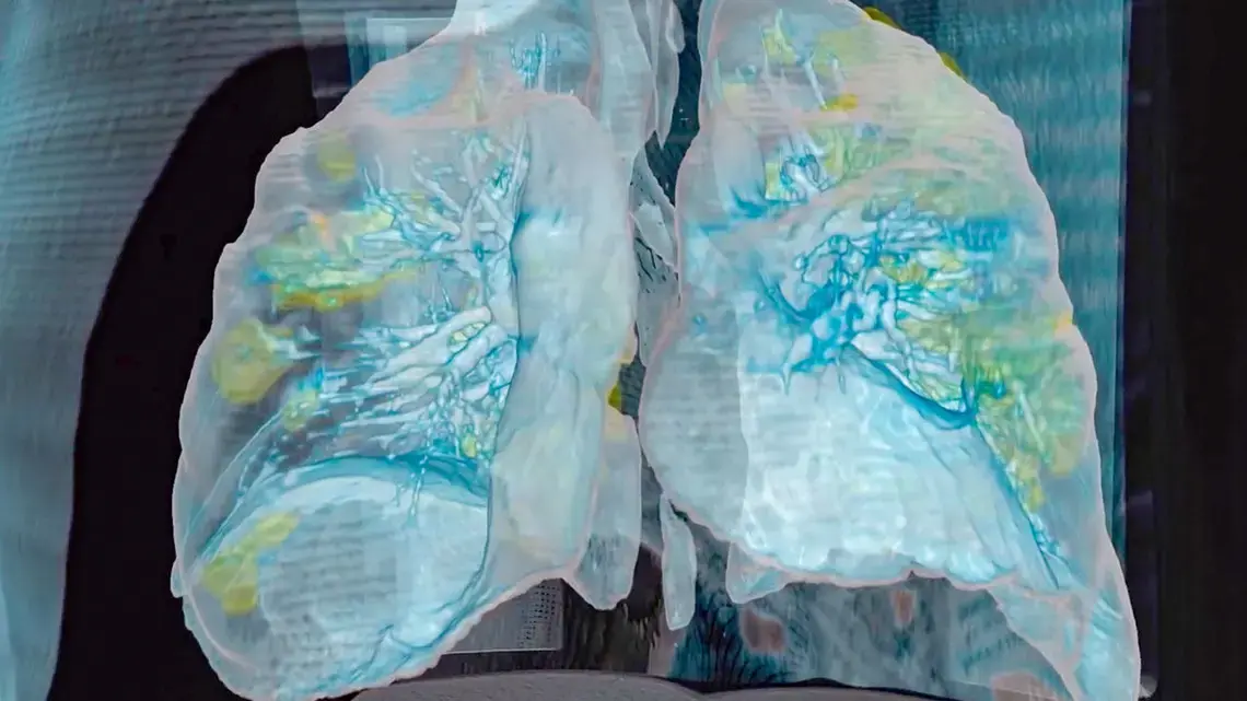 The coronavirus wreaked extensive damage (yellow) on the lungs of a 59-year-old man who died at George Washington University Hospital, as seen in a 3D model based on computerized tomography scans. Image courtesy George Washington Hospital and Surgical Theater. United States, 2020.