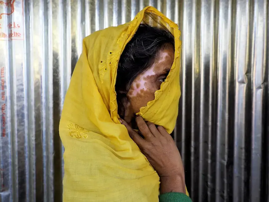 Scars A Rohingya refugee displays her scars. Image by Doug Bock Clark. Myanmar, 2017.