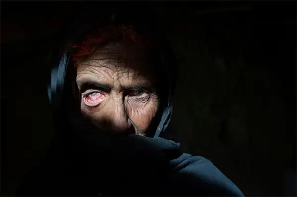 Bibi Naiz was blinded while fleeing war in Helmand. She survived a NATO airstrike that killed seven members of her family, including her husband and three children. Image by Paula Bronstein. Afghanistan, 2015. Media file: pdn-annual-bronstein.jpg