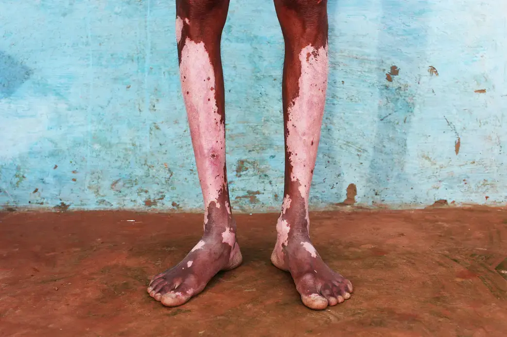 Chamilal, 55, stands outside his farmhouse in a small village near the city of Kanpur. He is one of many local farmers who suffer from serious skin conditions, believed to have been brought about by contact with toxic waste water from local tanneries. Image by Sean Gallagher. India, 2013. Media file: 02.india-pollution-gallagher-26.jpg