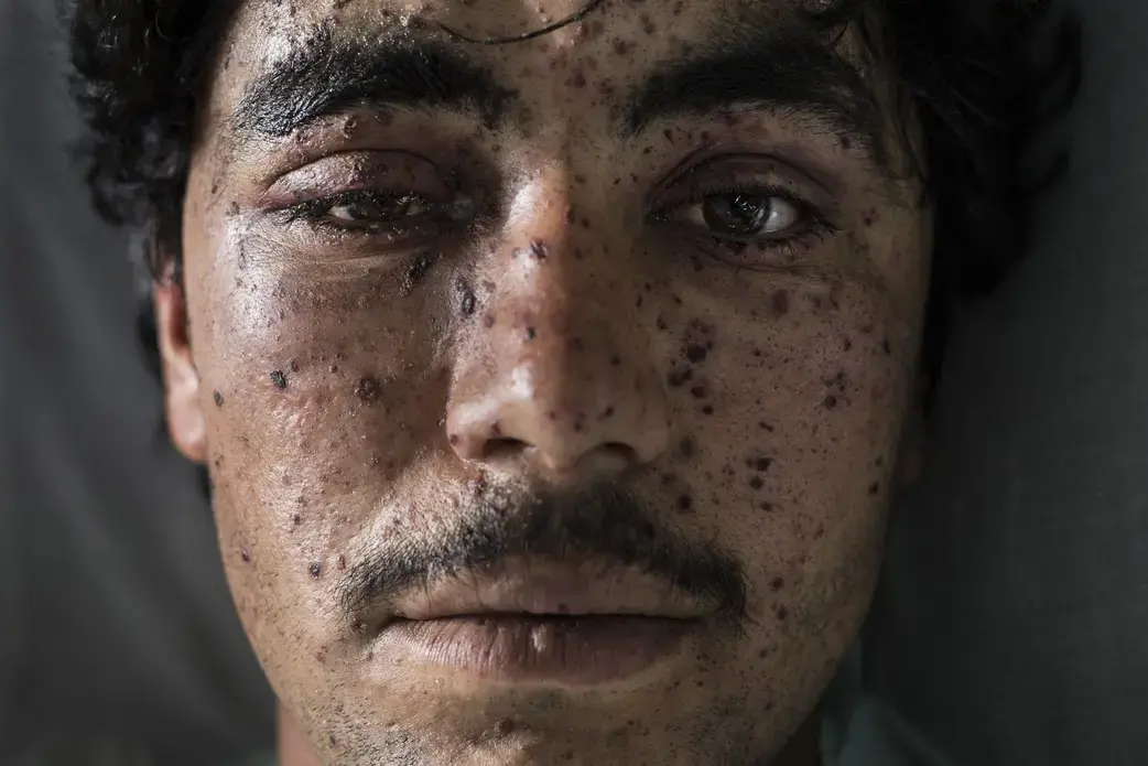 Kharim Ahmad,22, suffered shrapnel wounds on his face and the loss of a leg from fighting in Sangin. He was being treated at the Emergency hospital in Lashkar Gah on March 25. Image by Paula Bronstein. Afghanistan, 2016. Kharim Ahmad,22, suffered shrapnel wounds on his face and the loss of a leg from fighting in Sangin. He was being treated at the Emergency hospital in Lashkar Gah on March 25. Image by Paula Bronstein. Afghanistan, 2016.