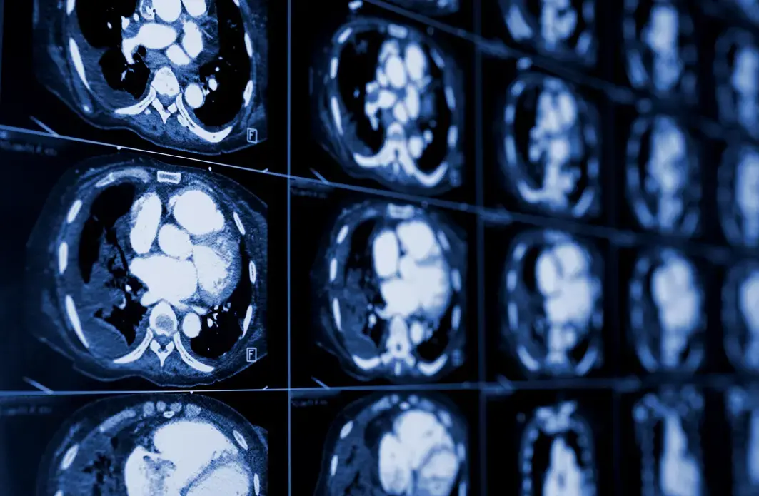 Computed tomography of the chest. Medical background. Monochrome photos. Image by sfam_photo/Shutterstock. Computed tomography of the chest. Medical background. Monochrome photos. Image by sfam_photo/Shutterstock.