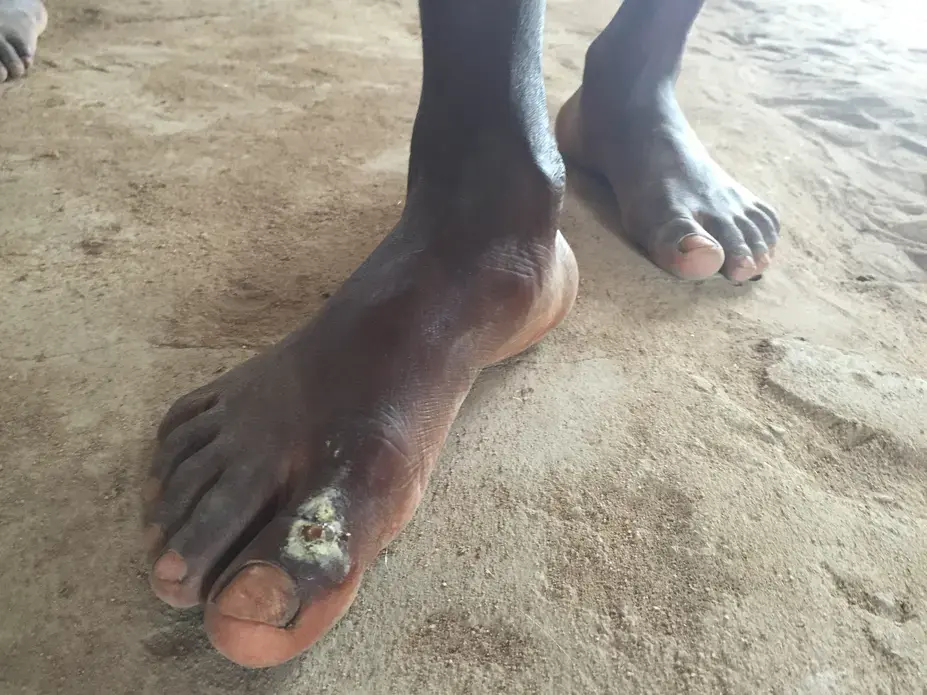 A sore is shown as being one of the harmful consequences from not wearing shoes. Image by Olivia Conti. Ghana, 2015. Media file: img_0904.jpg