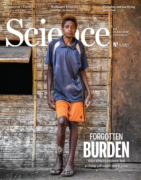 The Science Magazine cover for the award-winning story featured Stanis Malom, a 15-year old Papua boy whose leg is disfigured by yaws disease. Image by Brian Cassey. Papua New Guinea, 2018. The Science Magazine cover for the award-winning story featured Stanis Malom, a 15-year old Papua boy whose leg is disfigured by yaws disease. Image by Brian Cassey. Papua New Guinea, 2018.