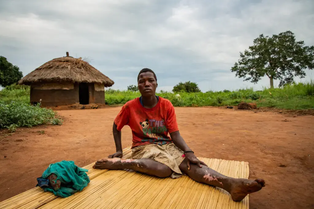 Milly Lakot, 19, was diagnosed with nodding syndrome in 2008. She suffered burns in 2016 after falling into a fire during a seizure. Image by Esther Ruth Mbabazi. Uganda, 2019. Milly Lakot, 19, was diagnosed with nodding syndrome in 2008. She suffered burns in 2016 after falling into a fire during a seizure. Image by Esther Ruth Mbabazi. Uganda, 2019.
