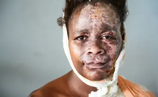 Mary burned her hair and face when she fell into the flames of an open fire on which she was heating water for tea. Mary has epilepsy and the accident happened whilst she was having a fit. She remembers nothing but the pain. Now she is being treated at Kamuzu Central Hospital's burns unit in Lilongwe - she is slowly on the mend. Image by Nathalie Bertrams. Malawi, 2017.