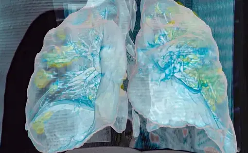 The coronavirus wreaked extensive damage (yellow) on the lungs of a 59-year-old man who died at George Washington University Hospital, as seen in a 3D model based on computerized tomography scans. Image courtesy George Washington Hospital and Surgical Theater. United States, 2020.