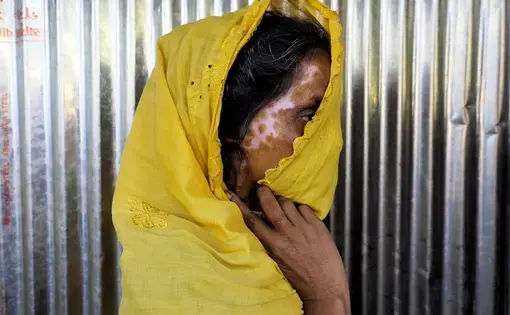 Scars A Rohingya refugee displays her scars. Image by Doug Bock Clark. Myanmar, 2017.