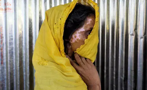  Rohingya refugee displays her burn scars. Image by Doug Bock Clark. Bangladesh, 2017.