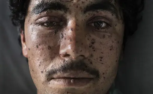 Kharim Ahmad,22, suffered shrapnel wounds on his face and the loss of a leg from fighting in Sangin. He was being treated at the Emergency hospital in Lashkar Gah on March 25. Image by Paula Bronstein. Afghanistan, 2016.