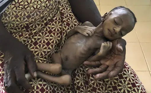 One-month old Haboue Solange Boue, awaiting medical care for severe malnutrition, is held by her mother, Danssanin Lanizou, 30, at the feeding center of the main hospital in the town of Hounde, Tuy Province, in southwestern Burkina Faso on Thursday, June 11, 2020. With the markets closed because of coronavirus restrictions, her family sold fewer vegetables. Lanizou is too malnourished to nurse her. Image by Sam Mednick/AP Photo. Burkina Faso, 2020.