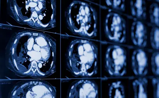 Computed tomography of the chest. Medical background. Monochrome photos. Image by sfam_photo/Shutterstock.