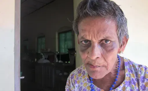 A patient at the Hendala Leprosy Hospital, Sri Lanka.