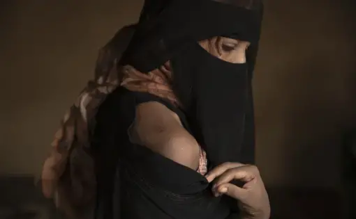 Ethiopian migrant Eman Idrees shows her shoulder with a wound from torture after being held and abused for eight months in a desert compound known in Arabic as a "hosh," run by an Ethiopian smuggler in Ras al-Ara. Image by Nariman El-Mofty. Yemen, 2019.