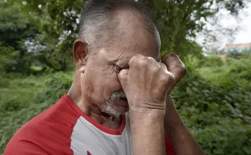 A man buries his face in his hands, which have been affected by leprosy.