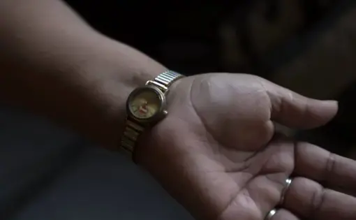 A woman is showing scars on her wrist, where she is also wearing a Tyson-branded wristwatch.