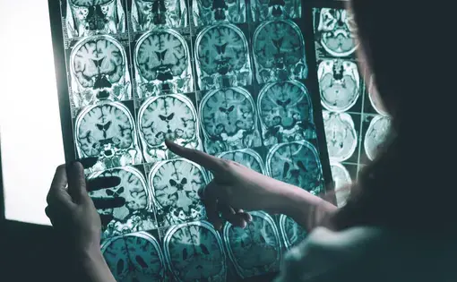 MRI scans of Alzheimer's patients