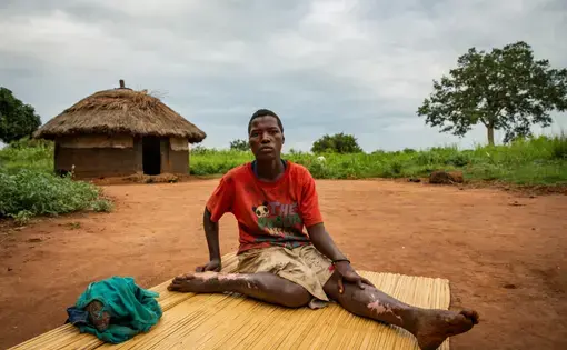 Milly Lakot, 19, was diagnosed with nodding syndrome in 2008. She suffered burns in 2016 after falling into a fire during a seizure. Image by Esther Ruth Mbabazi. Uganda, 2019.