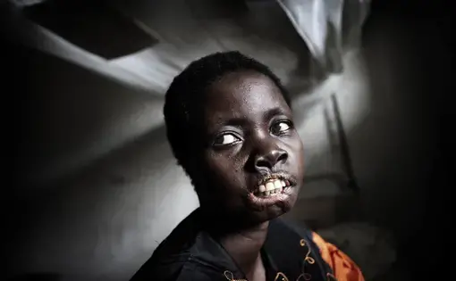 Mbonih Ndele Mari was abducted by the LRA outside Niangara and left for dead by them after they cut off her lips and her ears. She is now in a hospital in Niangara. Her children are being looked after by family close by.