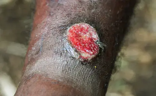 Bacteria from yaws ulcers can infect another person when they enter through wounds or scratches. Image by Brian Cassey. Papua New Guinea, 2018. 