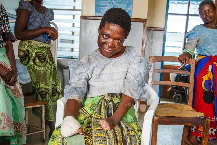 Epilepsy. Image by Nathalie Bertrams. Malawi, 2017.