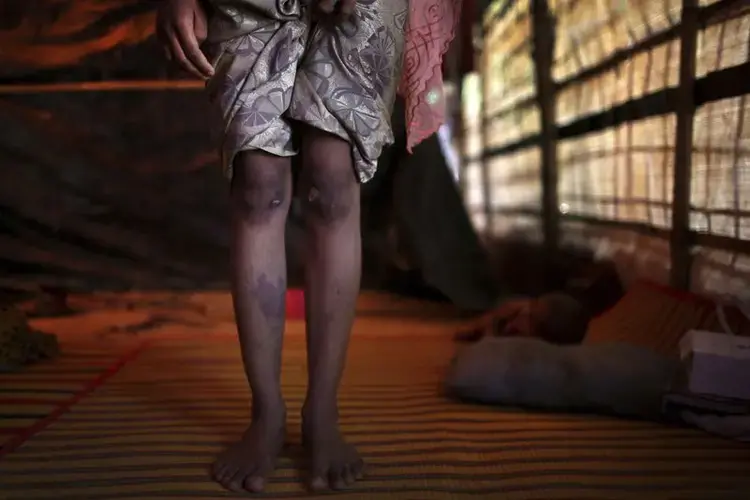 R, 13, shows the scars on her knees and right shin from injuries obtained when members of Myanmar’s armed forces dragged her out of her house before gang raping her. Image by Wong Maye-E. Bangladesh, 2017.