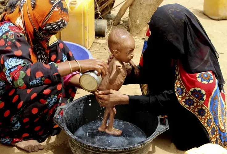 A severely malnourished infant is bathed in a bucket in Aslam, Hajjah. Image by Hammadi Issa/AP Photo. Yemen, 2018.