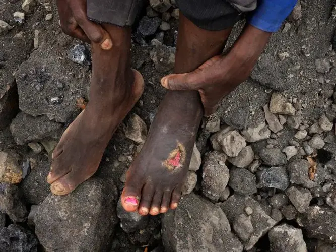 Injuries are common at Black Mountain. This miner was injured when a large rock fell on his foot. Image by Larry C. Price. Zambia, 2017.