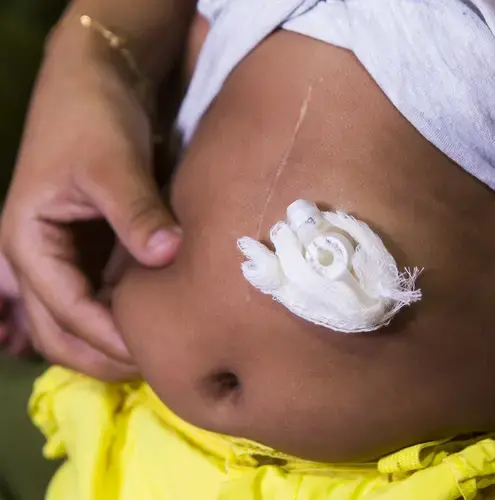 Valentina Vitoria Lopes' feeding tube and surgical scar. Image by Mark Hoffman. Brazil, 2017.