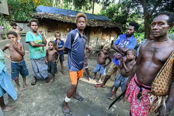 Stanis Malom's (center) untreated infection caused an open wound on his shin. He no longer attends school. Image by Brian Cassey. Papua New Guinea, 2018.