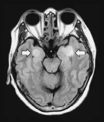 A 58-year-old woman with COVID-19 developed encephalitis, resulting in tissue damage in the brain (arrows). N. Poyiadji et al., Radiology, (2020). doi.org/10.1148/radiol.2020201187<br />