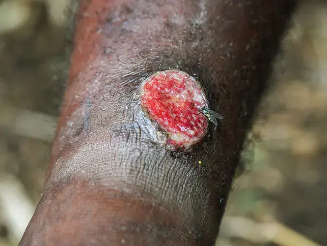Bacteria from yaws ulcers can infect another person when they enter through wounds or scratches. Image by Brian Cassey. Papua New Guinea, 2018.