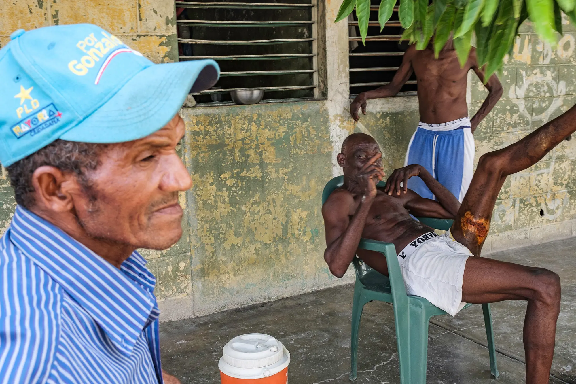 A man shows his burn wounds