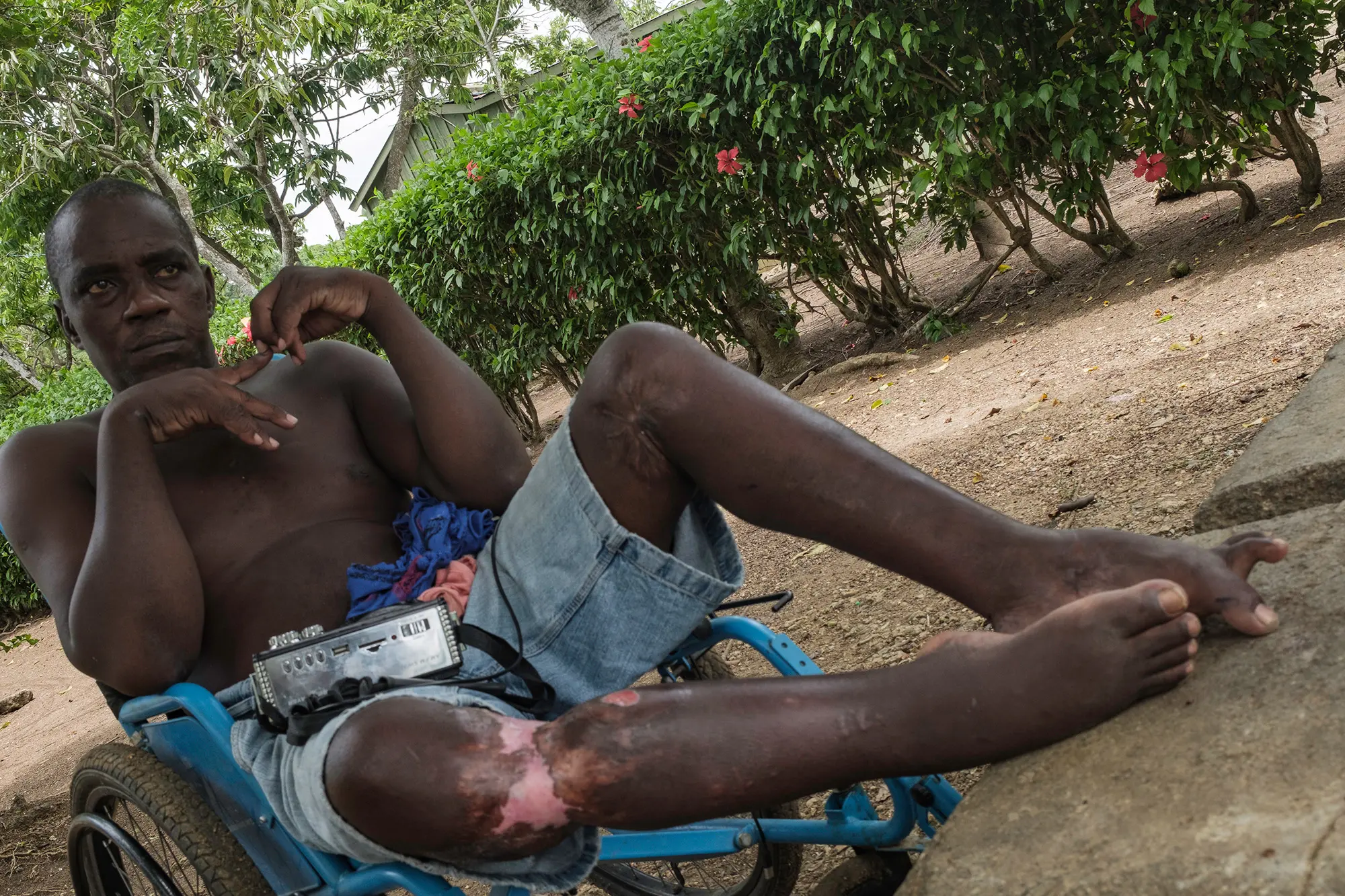 A man sits in a wheelchair after a sugarcane accident 